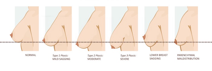لماذا يتم اللجوء لعملية تكبير الثدي
