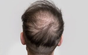 الأمثلة على اختلاف تكلفة زراعة الشعر بين المدن التركية